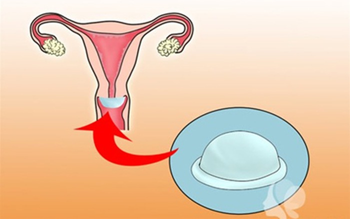 Vị trí đặt màng ngăn tránh thai
