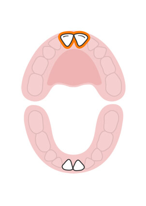răng cửa giữa hàm trên