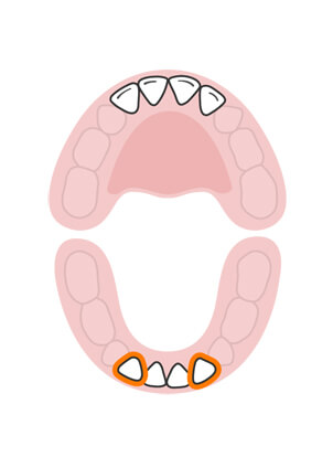 răng cửa bên hàm dưới