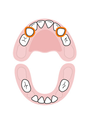 răng nanh hàm trên