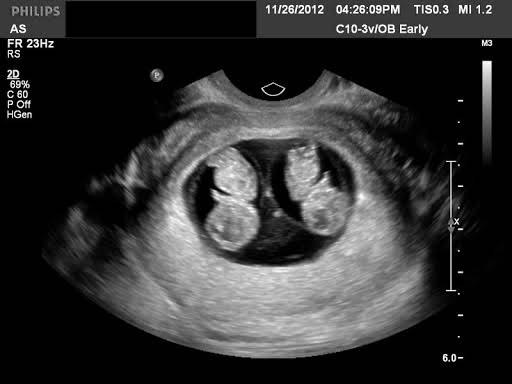 hình ảnh siêu âm thai đôi 8 tuần