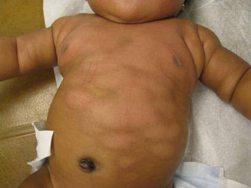 Trẻ bị lang ben thường có các vùng da không đều màu