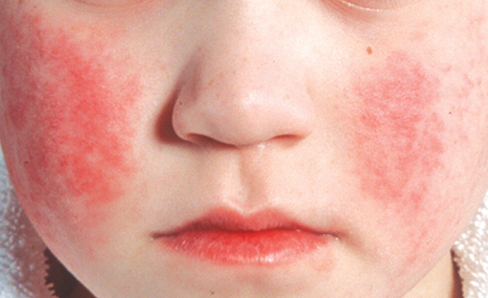  Triệu chứng ban đỏ nhiễm khuẩn là hai má bé đỏ ửng