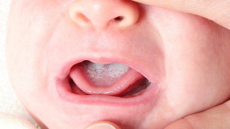 Vệt trắng tưa miệng trong miệng trẻ