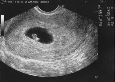 Kích thước túi thai có ảnh hưởng đến việc phôi thai có tim hay không?
