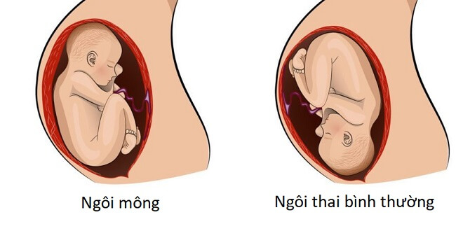 Tư thế của em bé trong bụng có liên quan đến vị trí thai nhi khi sinh?
