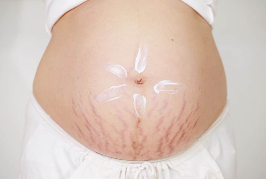 Hình ảnh rạn da khi mang thai