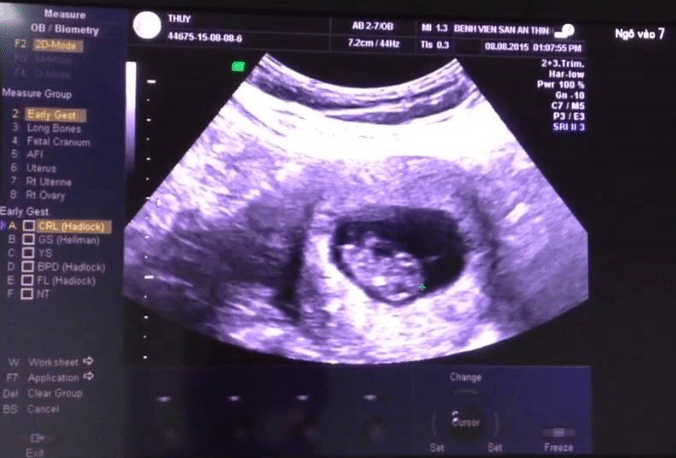 Hình ảnh siêu âm thai nhi 9 tuần tuổi