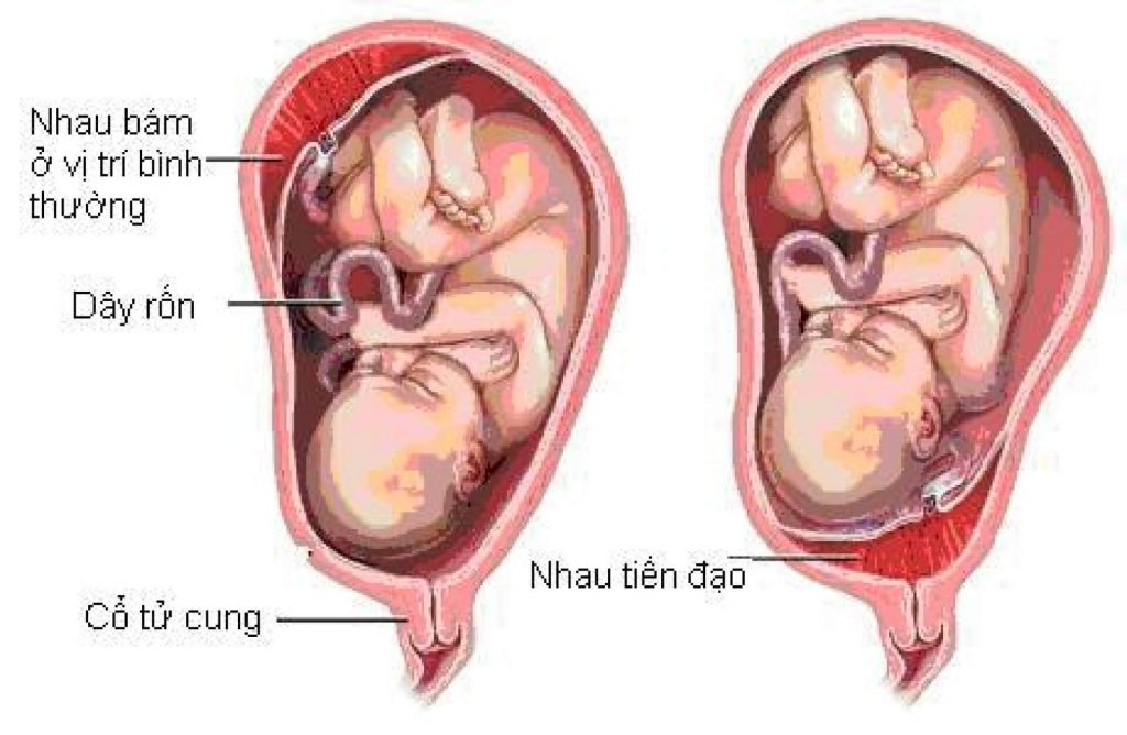 Nhau tiền đạo và cách điều trị nhau tiền đạo là gì