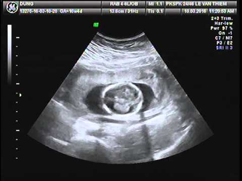 Siêu âm thai 16 tuần tuổi