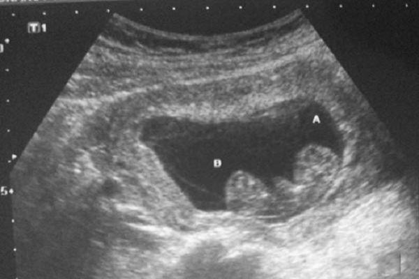 Hình ảnh siêu âm thai 7 tuần