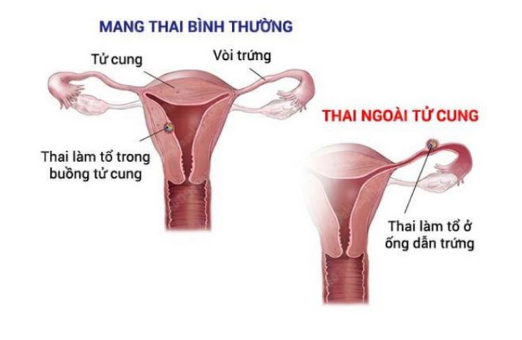 Thai ngoài tử cung là gì